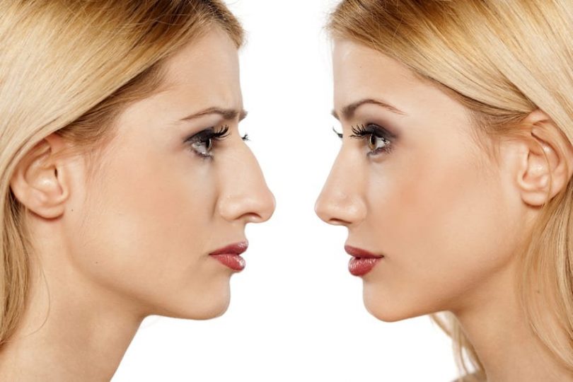 A Comprehensive Look at the Factors That Affect Rhinoplasty Costs